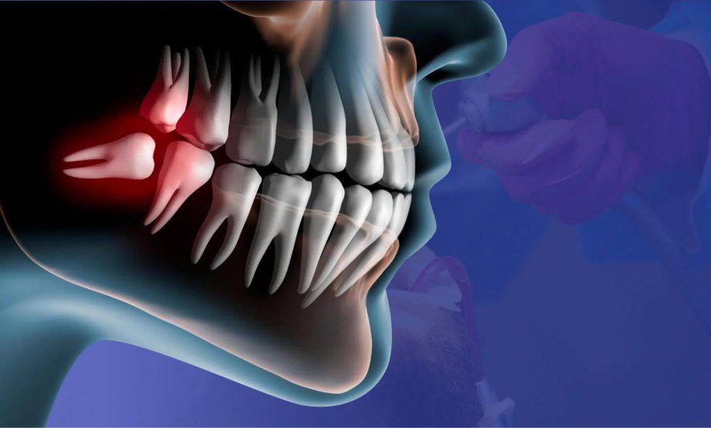 Can Wisdom Teeth Come Back? Understanding the Myths and Facts